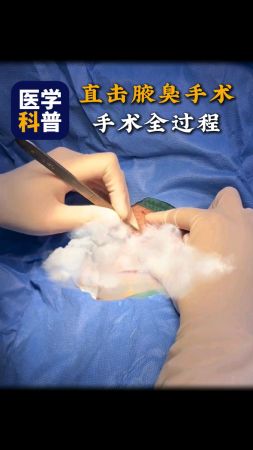腋臭手术全过程,做完轻松无异味.
