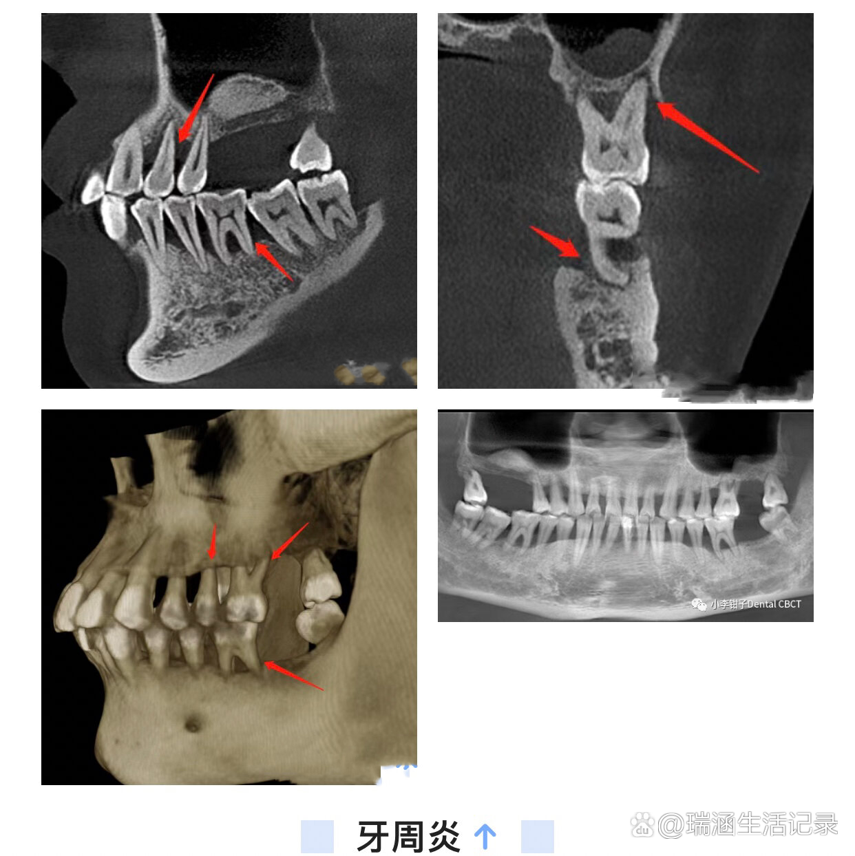 下颌囊肿,根尖囊肿,根管治疗,牙瘤成釉细胞瘤等病例影像