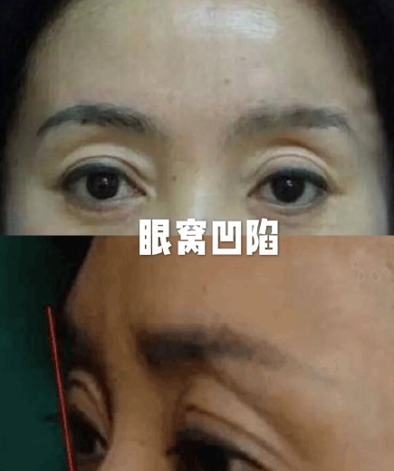 眼窝凹陷其实挺好看的图片