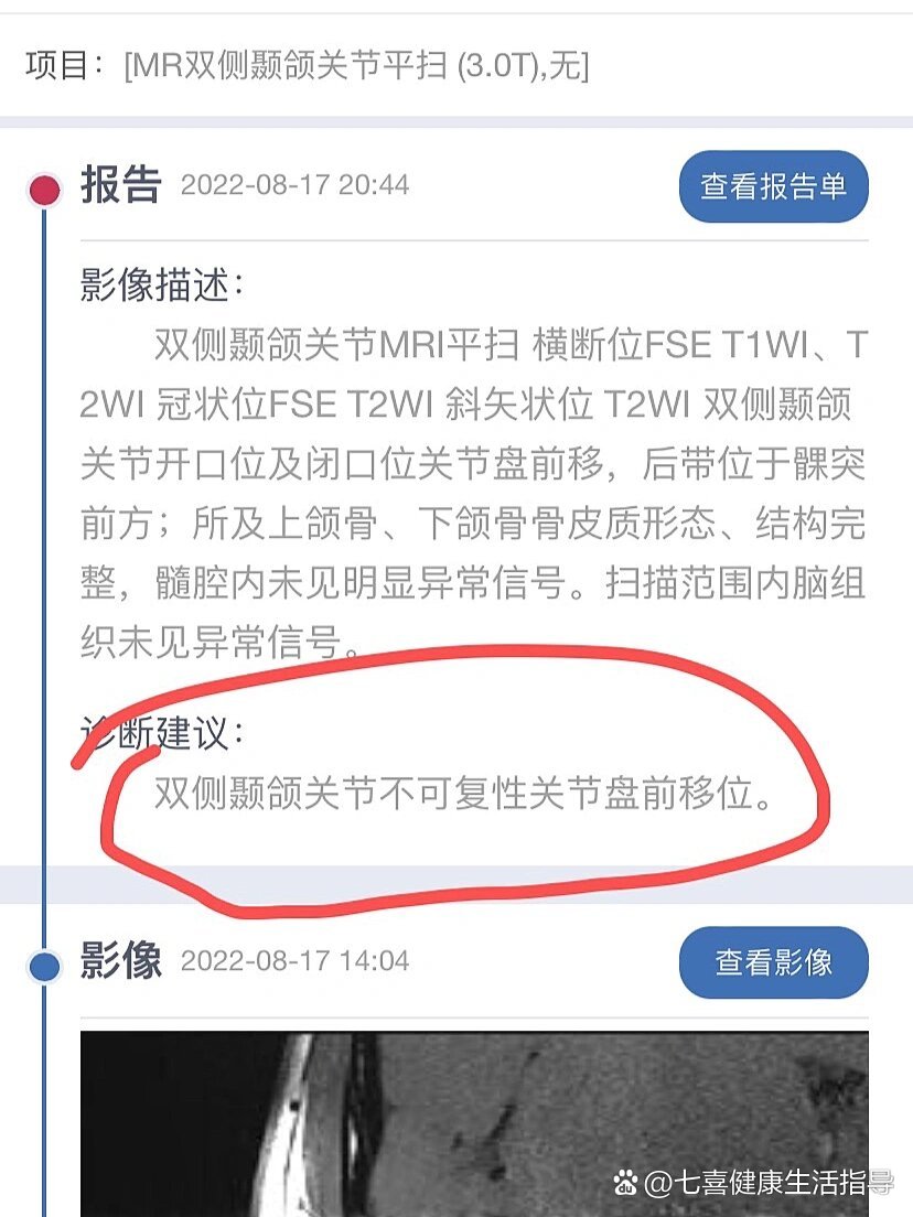 双侧颞颌关节不可复性关节盘前移位