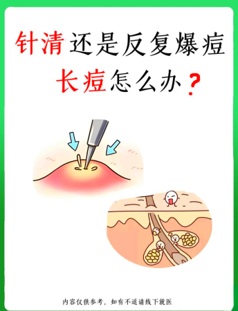 针清痘痘的那些事儿，你知道多少？