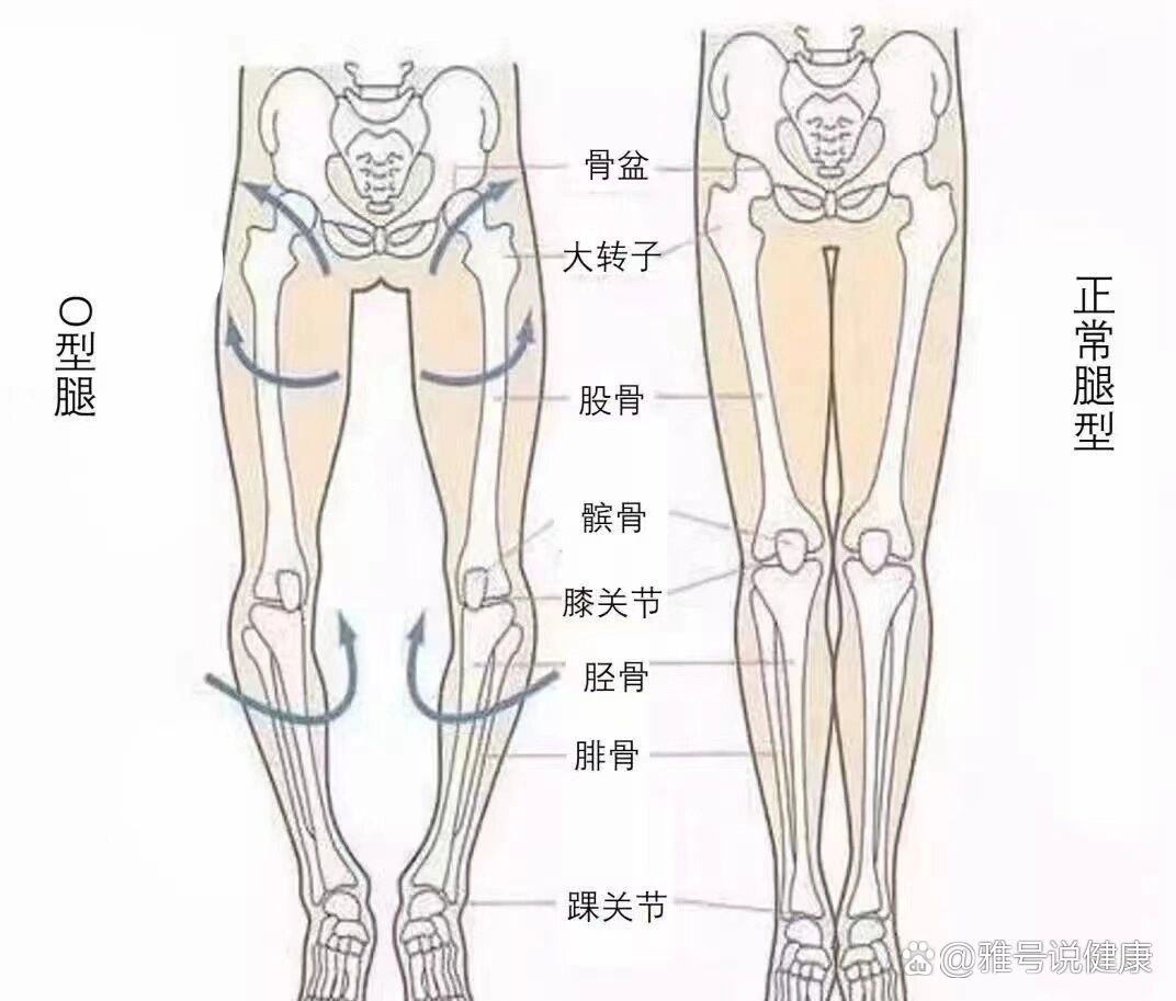 轻微o型腿怎么矫正图片