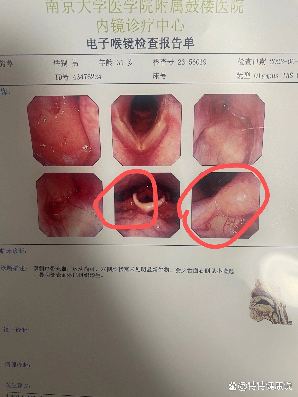 喉咙异物感