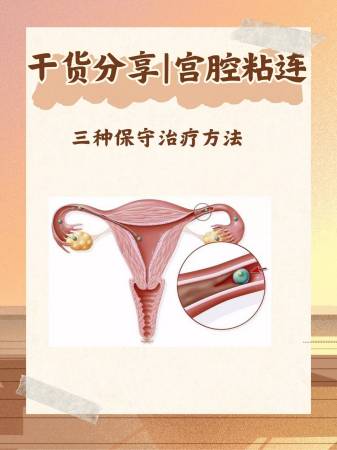 干货分享|宫腔粘连三种保守治疗方法