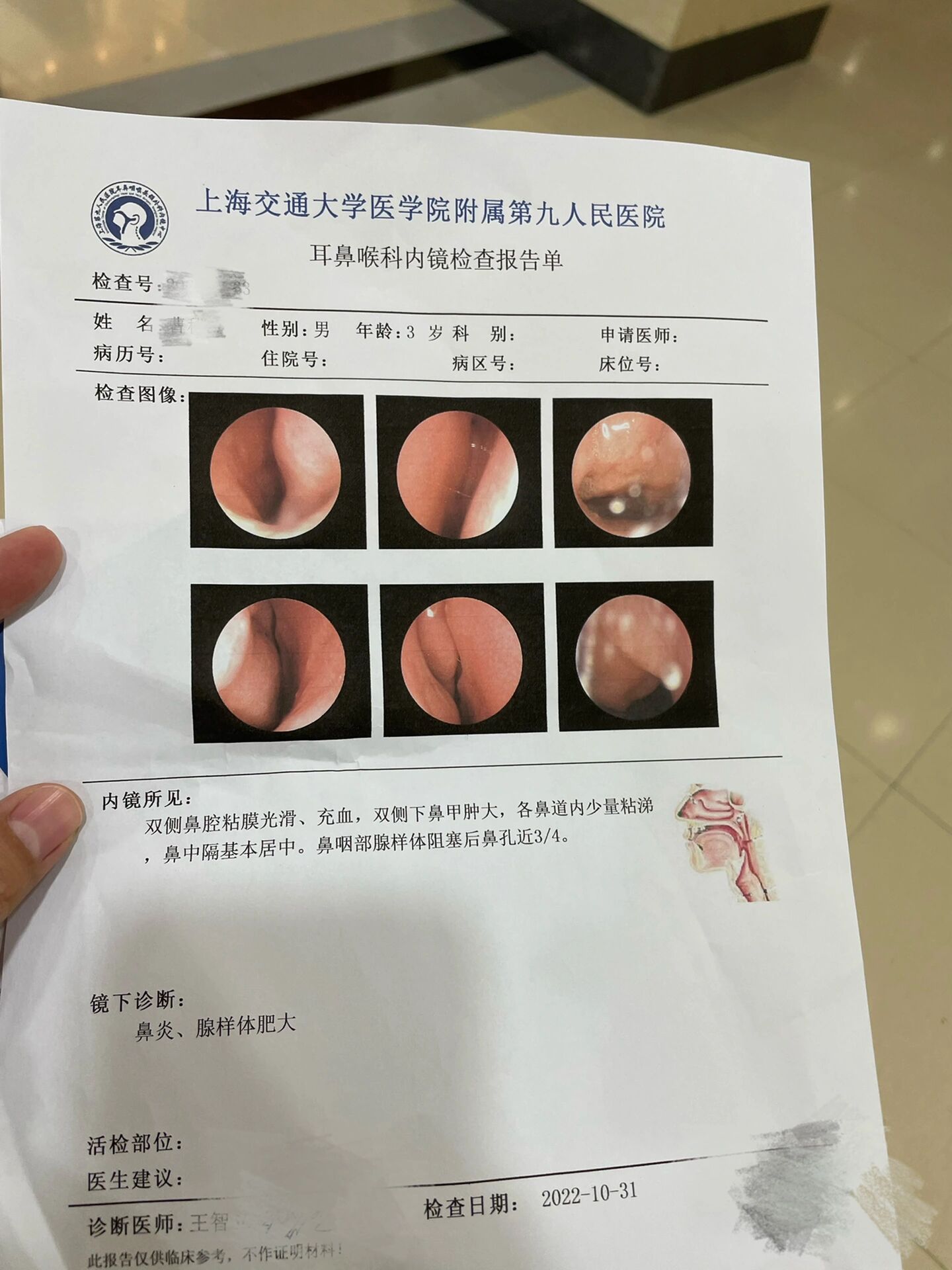 腺样体扁桃体手术该选择哪个医生