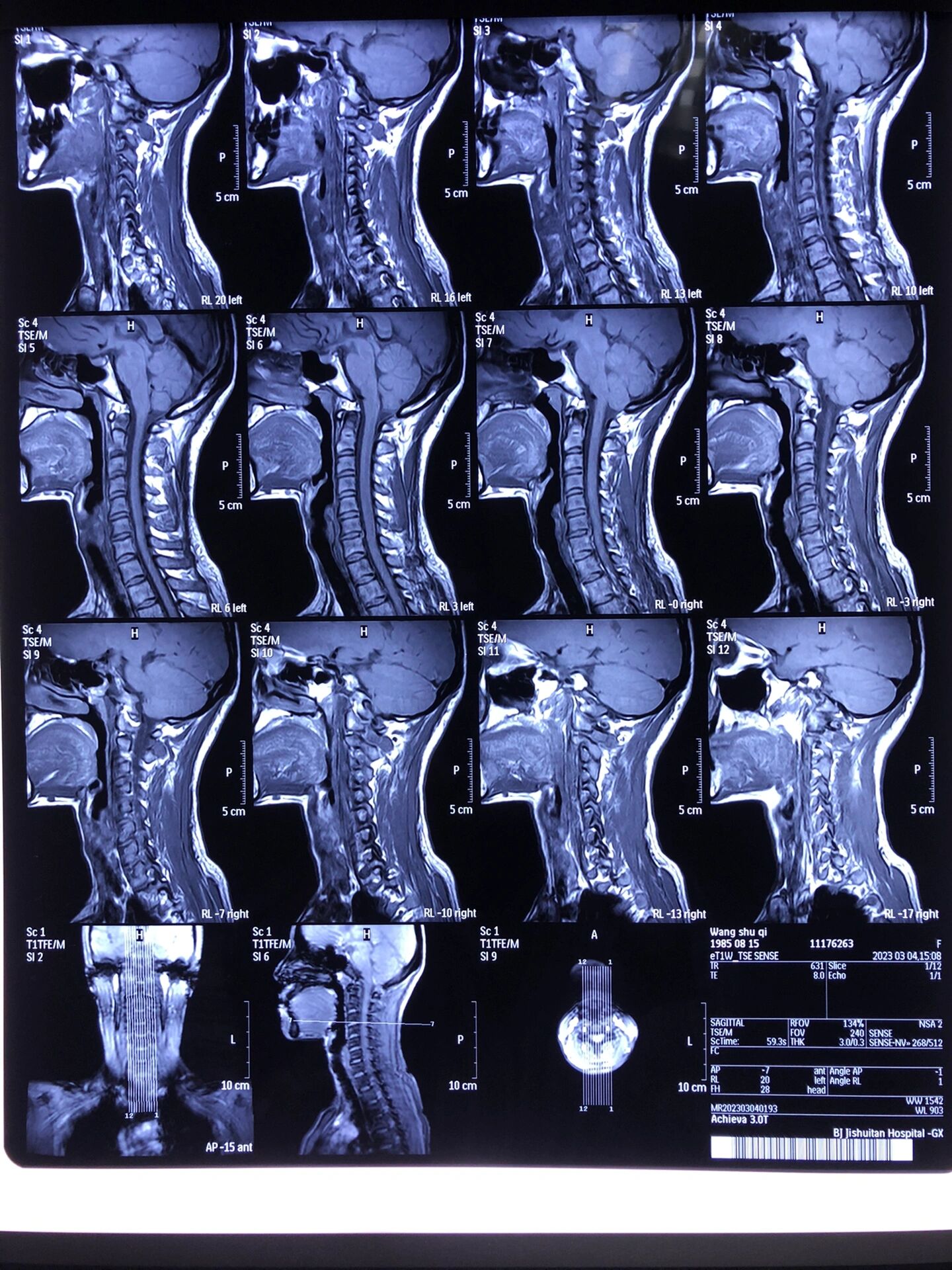 神经根型颈椎病入住积水潭间盘缩小不用手术