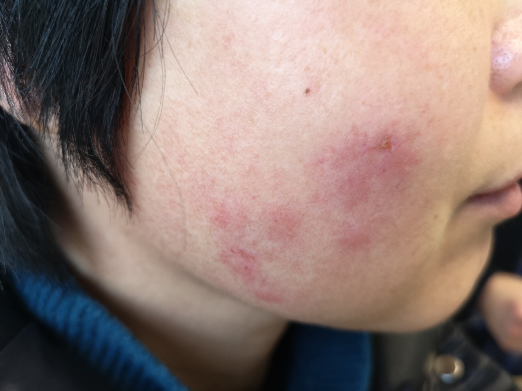 面部,手背红色斑块一月