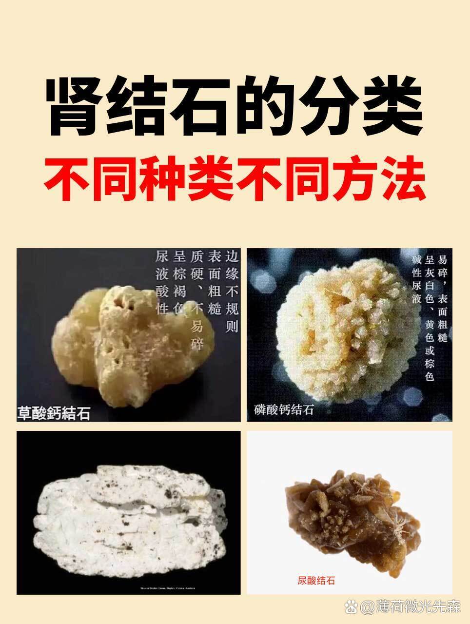  br>肾结石是中医常见的泌尿系统疾病,其矿物质类型主要分为四种: br>