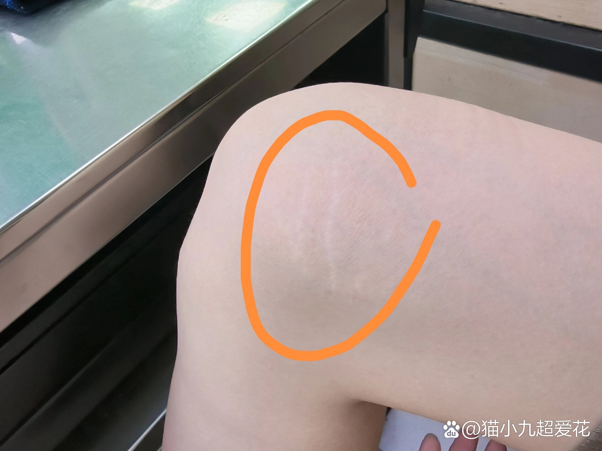 为啥膝盖处有一条条白纹?