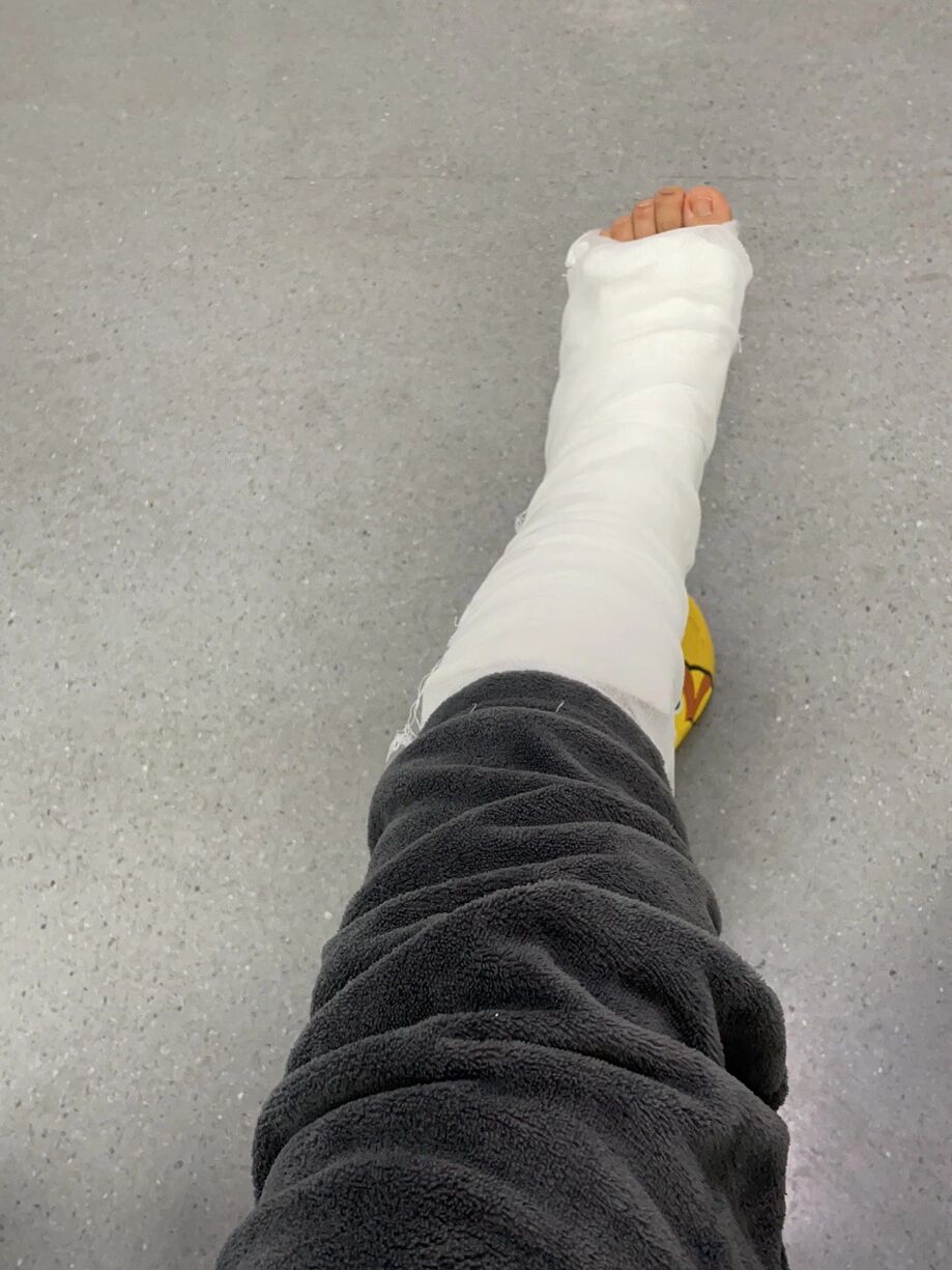 第五跖骨基底部骨折25天,石膏第19天