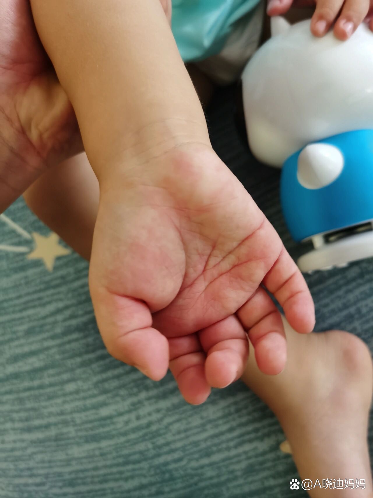 2岁半宝宝手心发红痒,一阵一阵的怎么办?