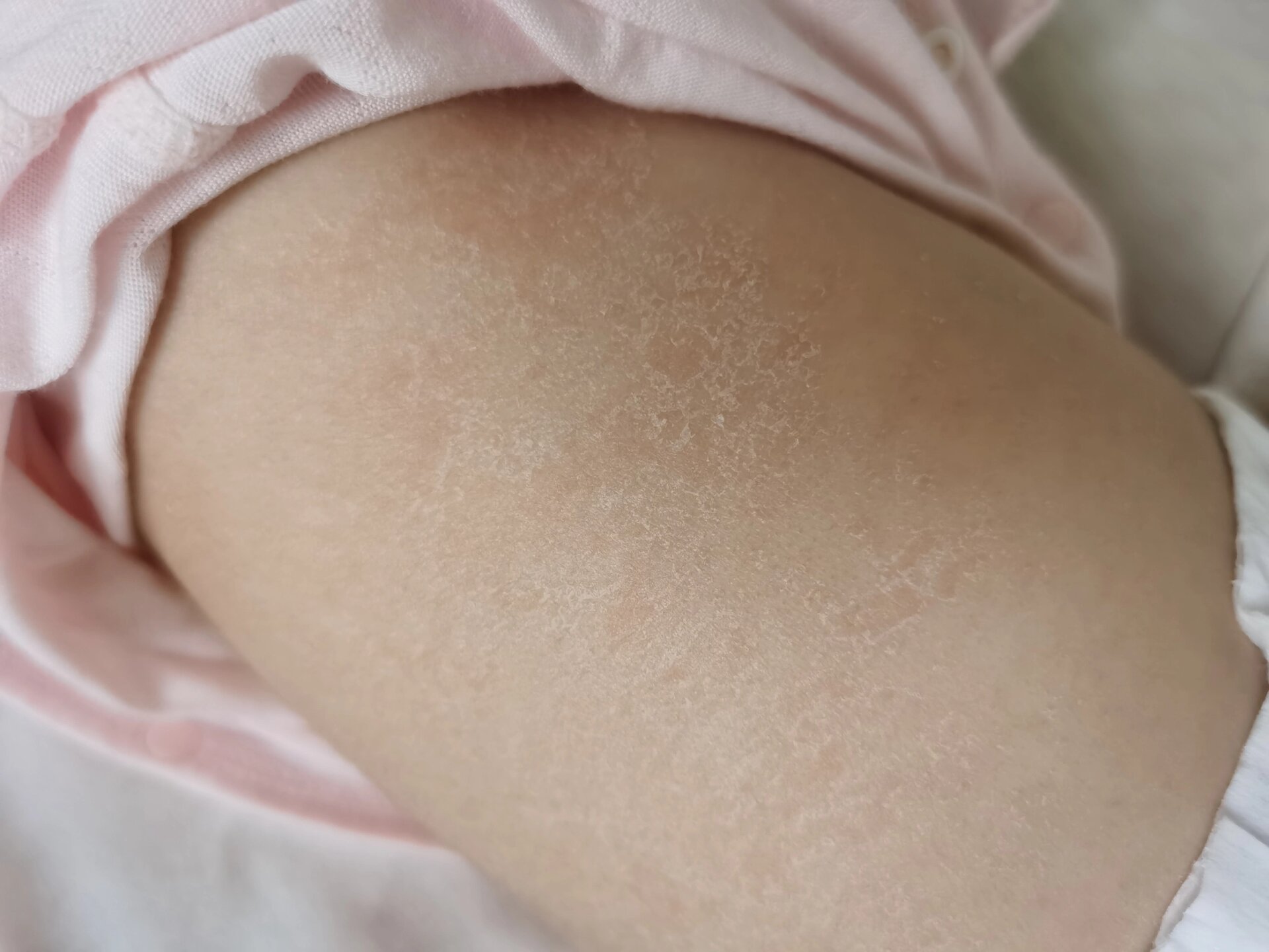 宝宝背上起皮好干,为啥