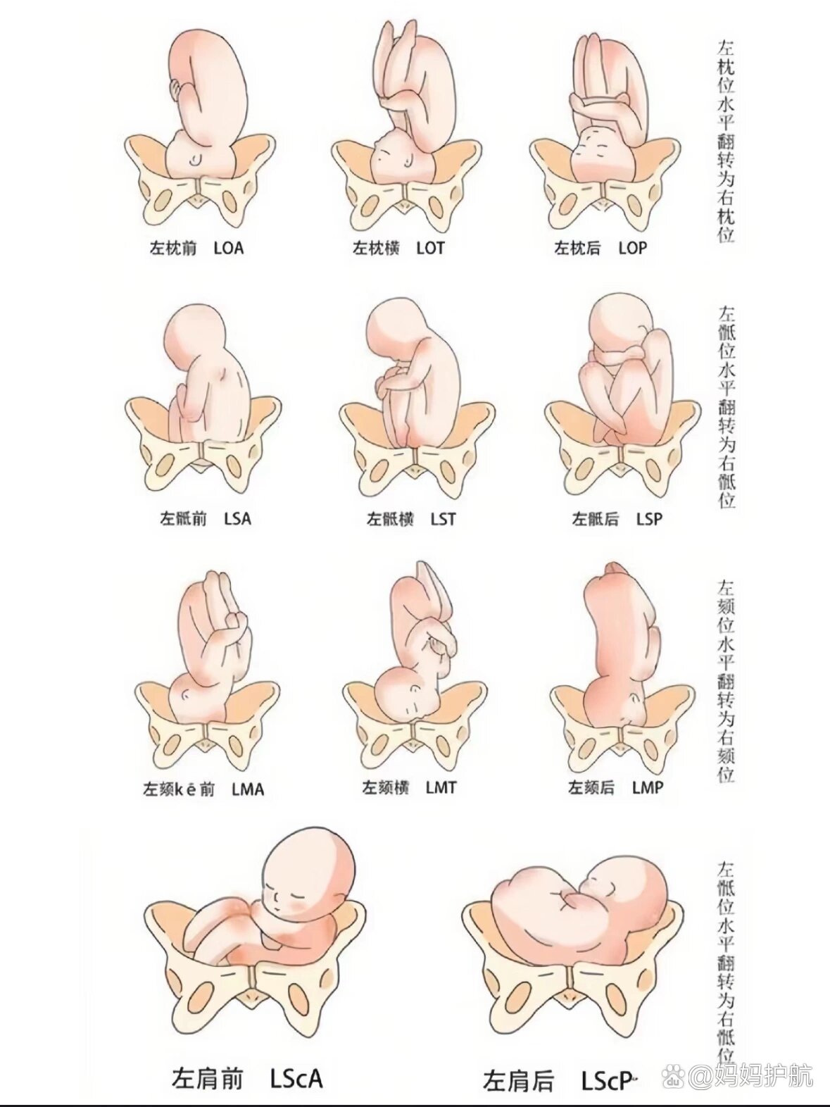 37 4臀位转为头位啦!