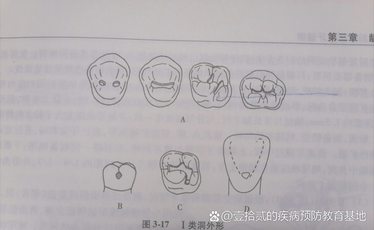 补牙手机去腐制备洞型1类洞和2类洞
