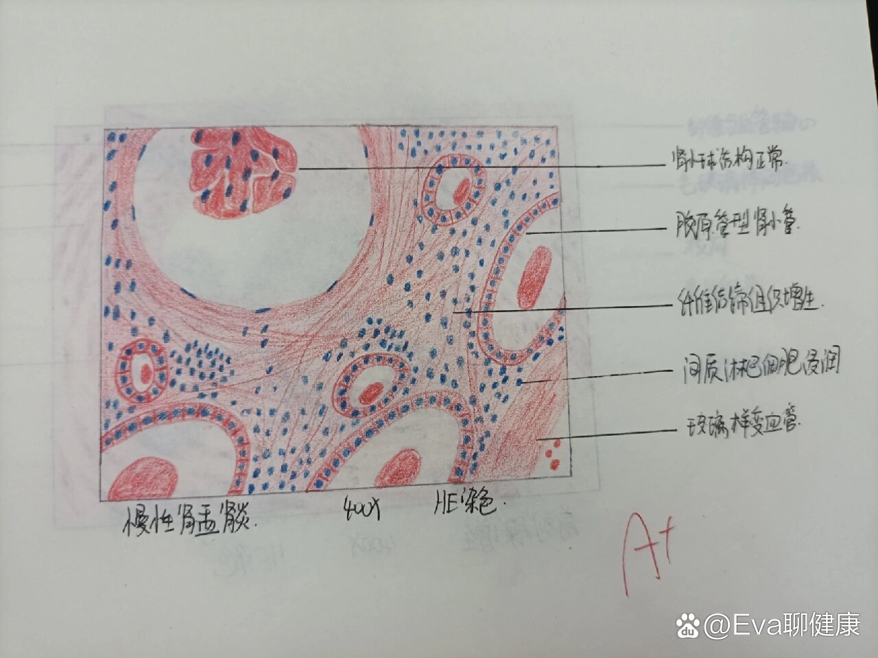 流行性乙型脑炎手绘图图片