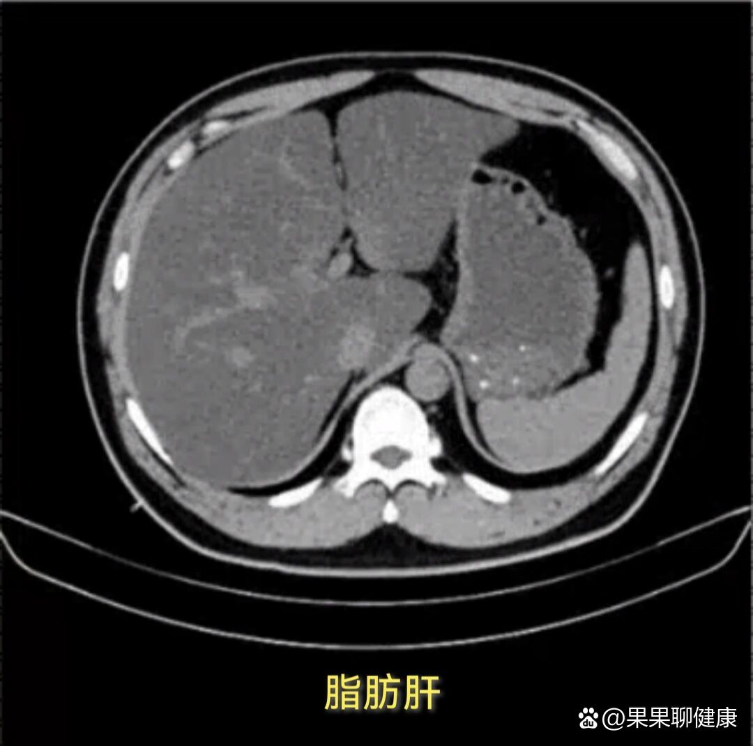 脂肪肝ct表现图片图片