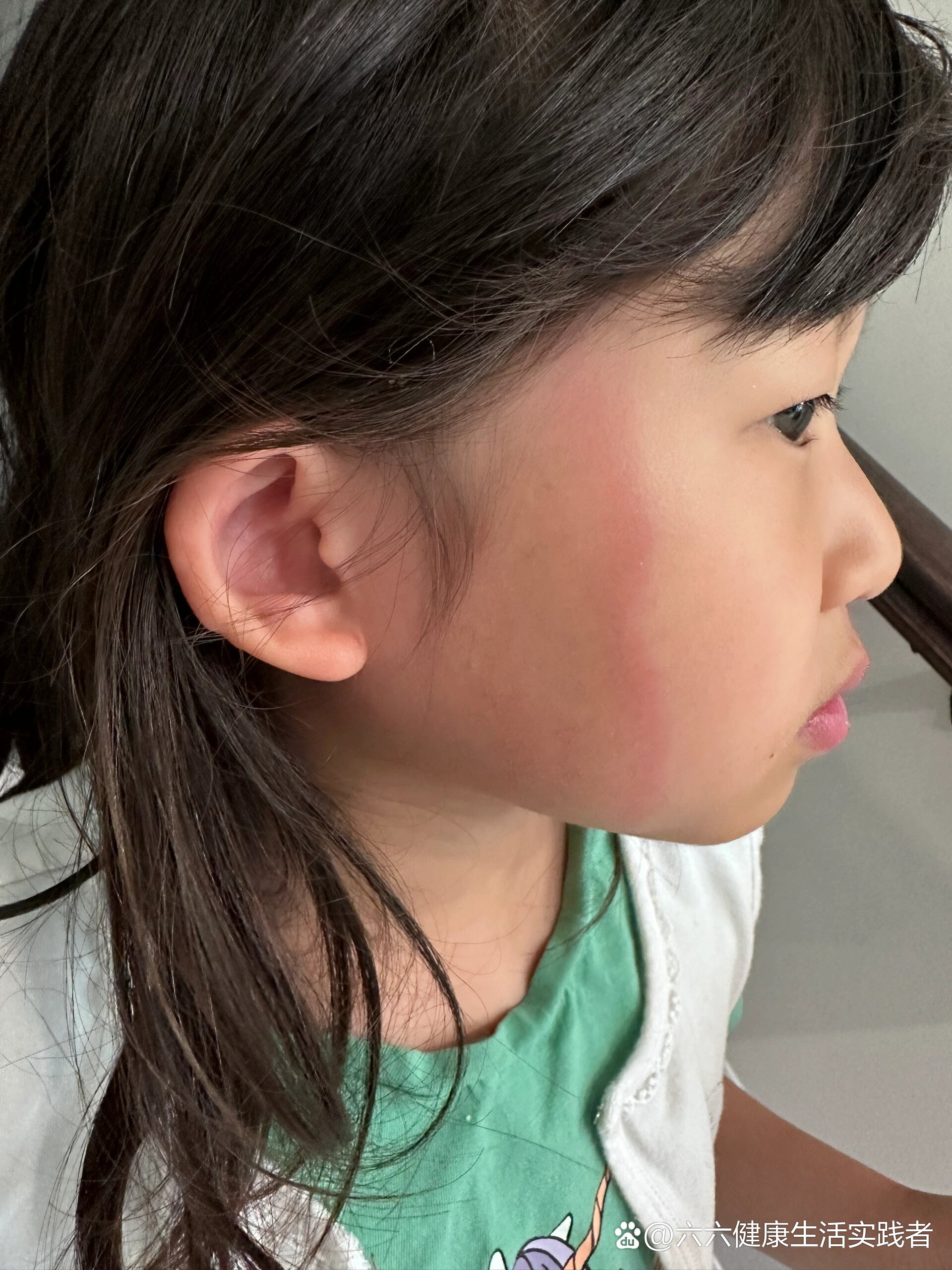 孩子脸上出现一道红印,不疼不痒,刚开始的时候微微有