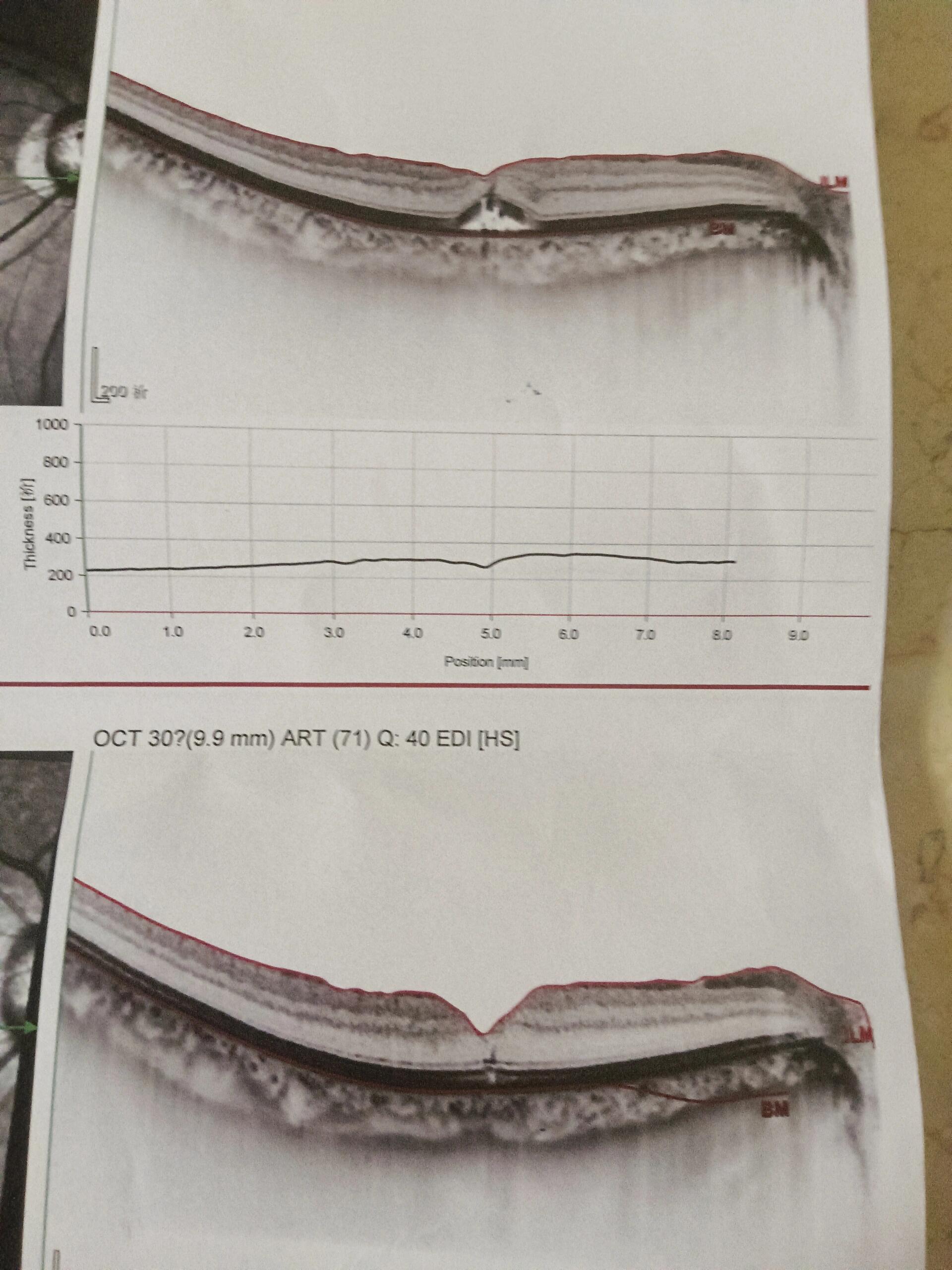 黄斑裂孔手术