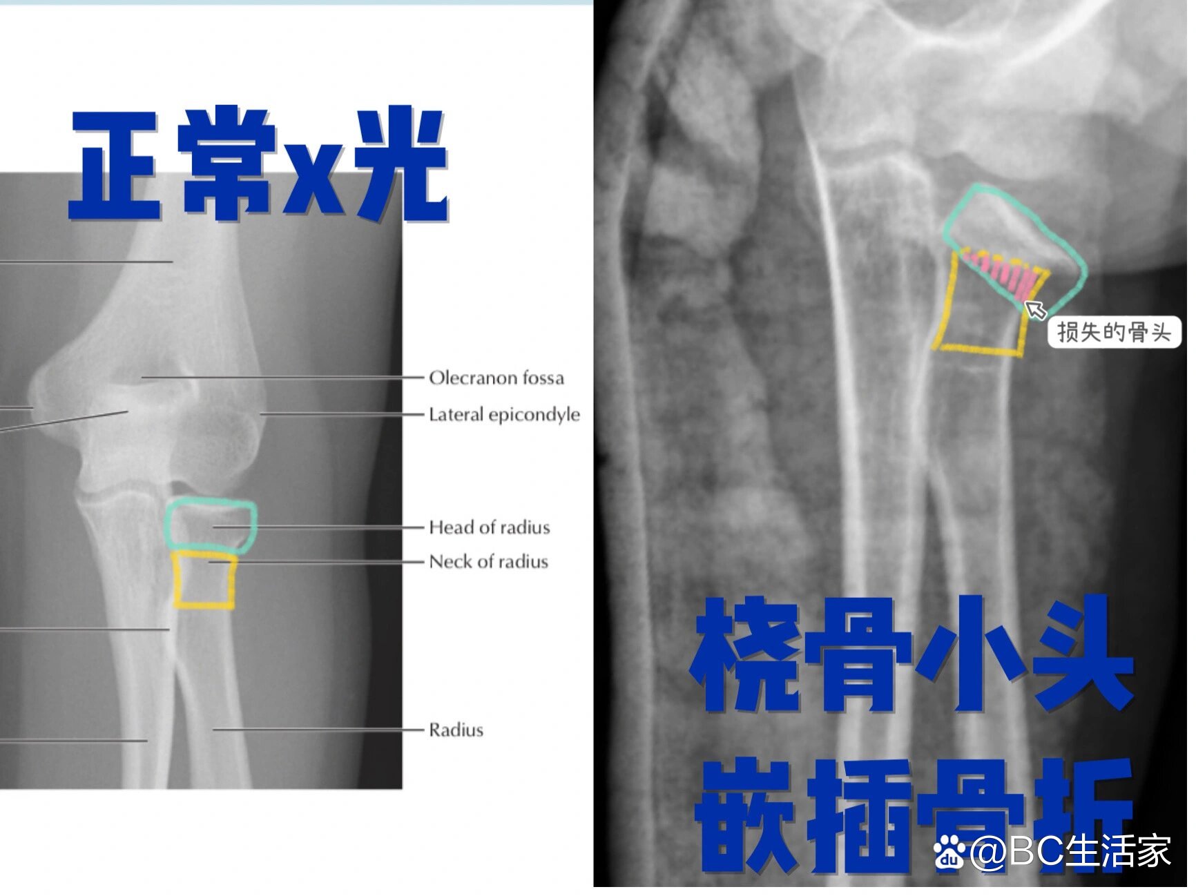 桡骨小头半图片