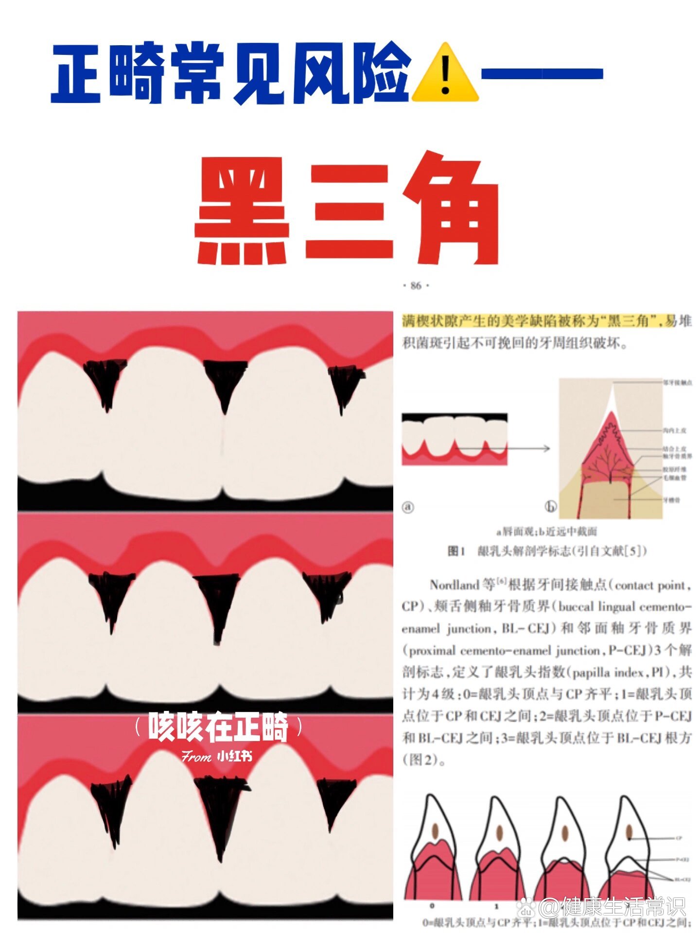 正畸出现黑三角图片