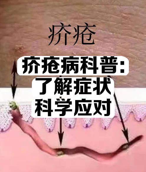疥疮病科普：了解症状，科学应对