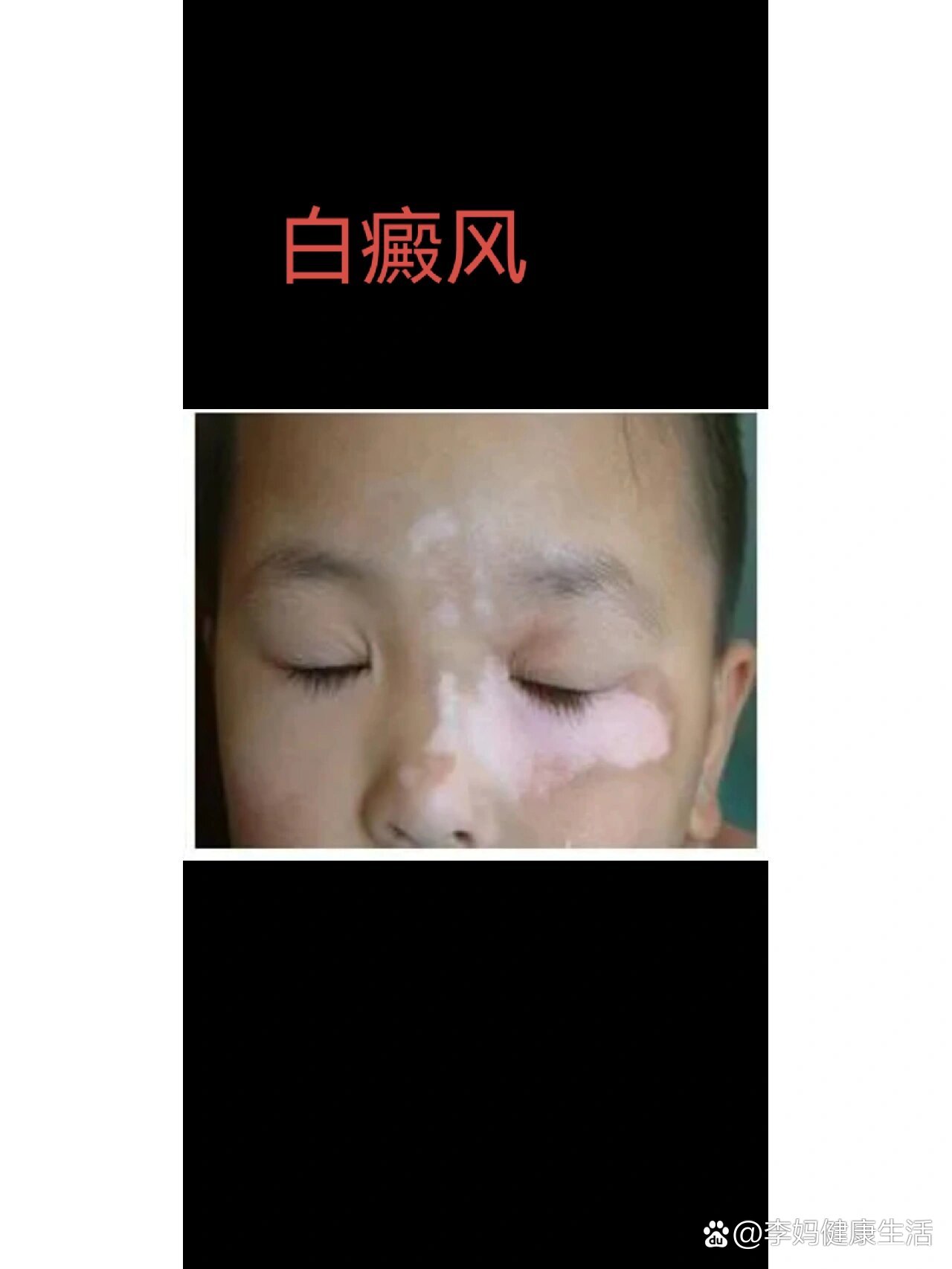 小孩子白色糠疹