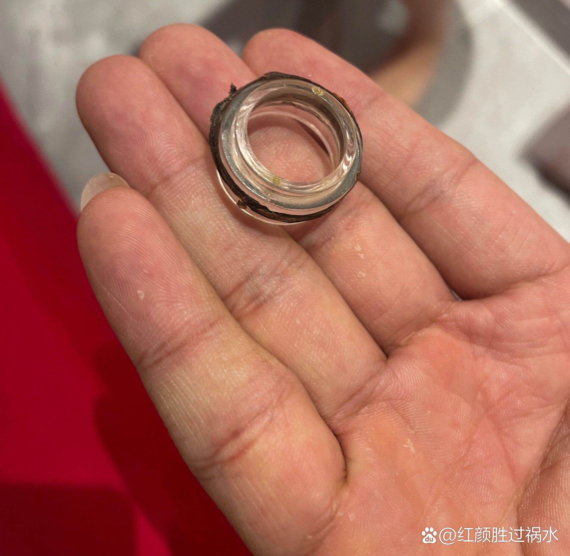 包皮套环手术