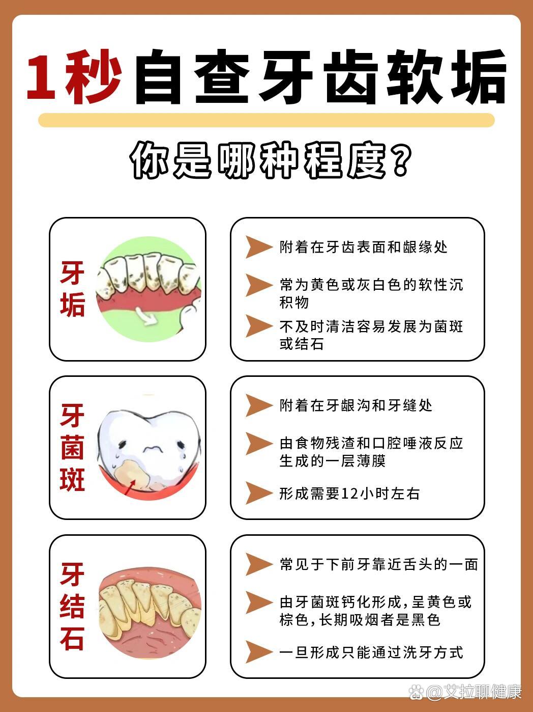 这些软垢其实就是食物残渣→牙菌斑→牙结石