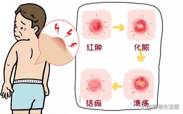 疖子的原因图片