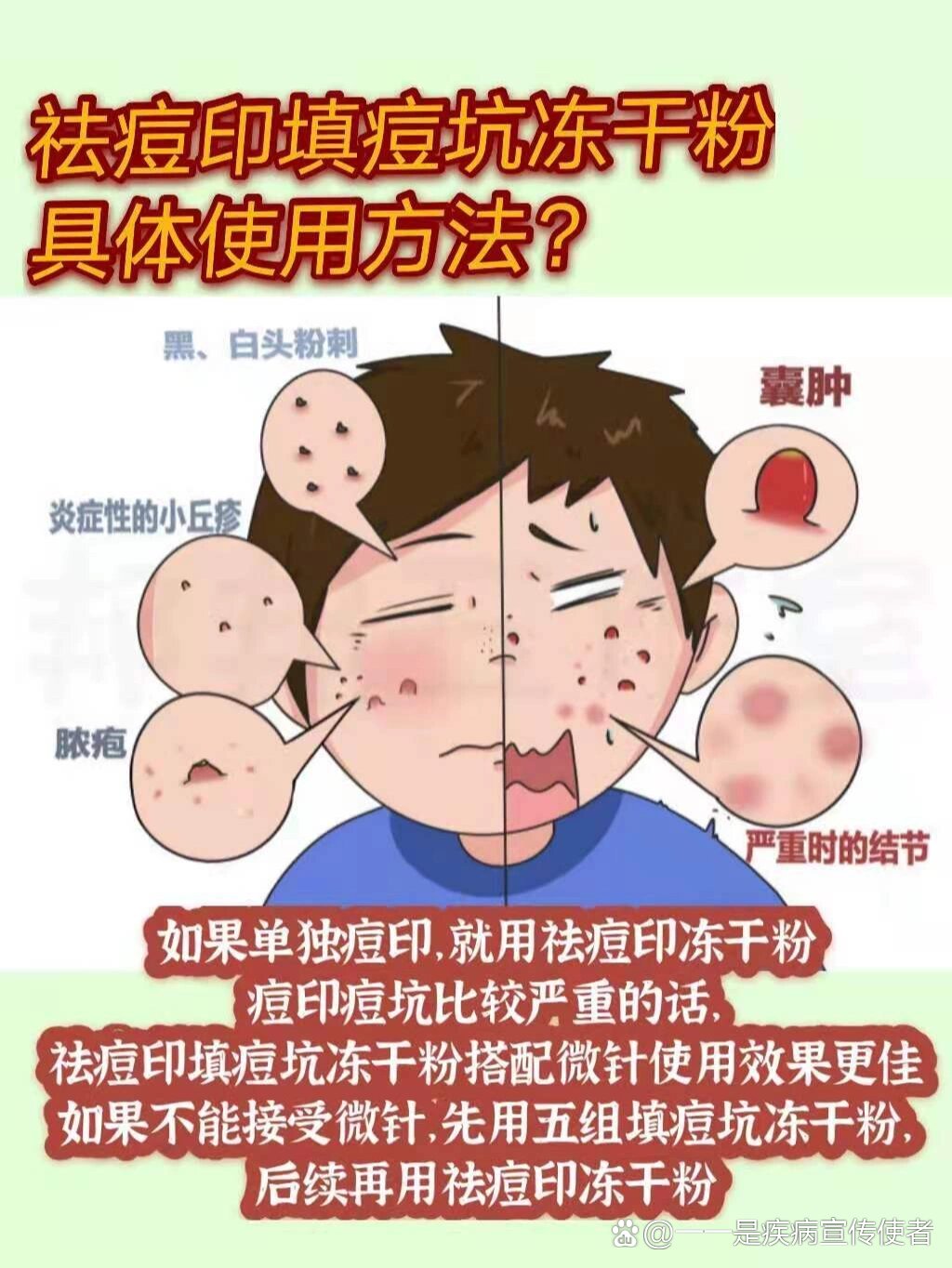 囊肿结节型痘痘处理办法(二)祛痘印填痘坑