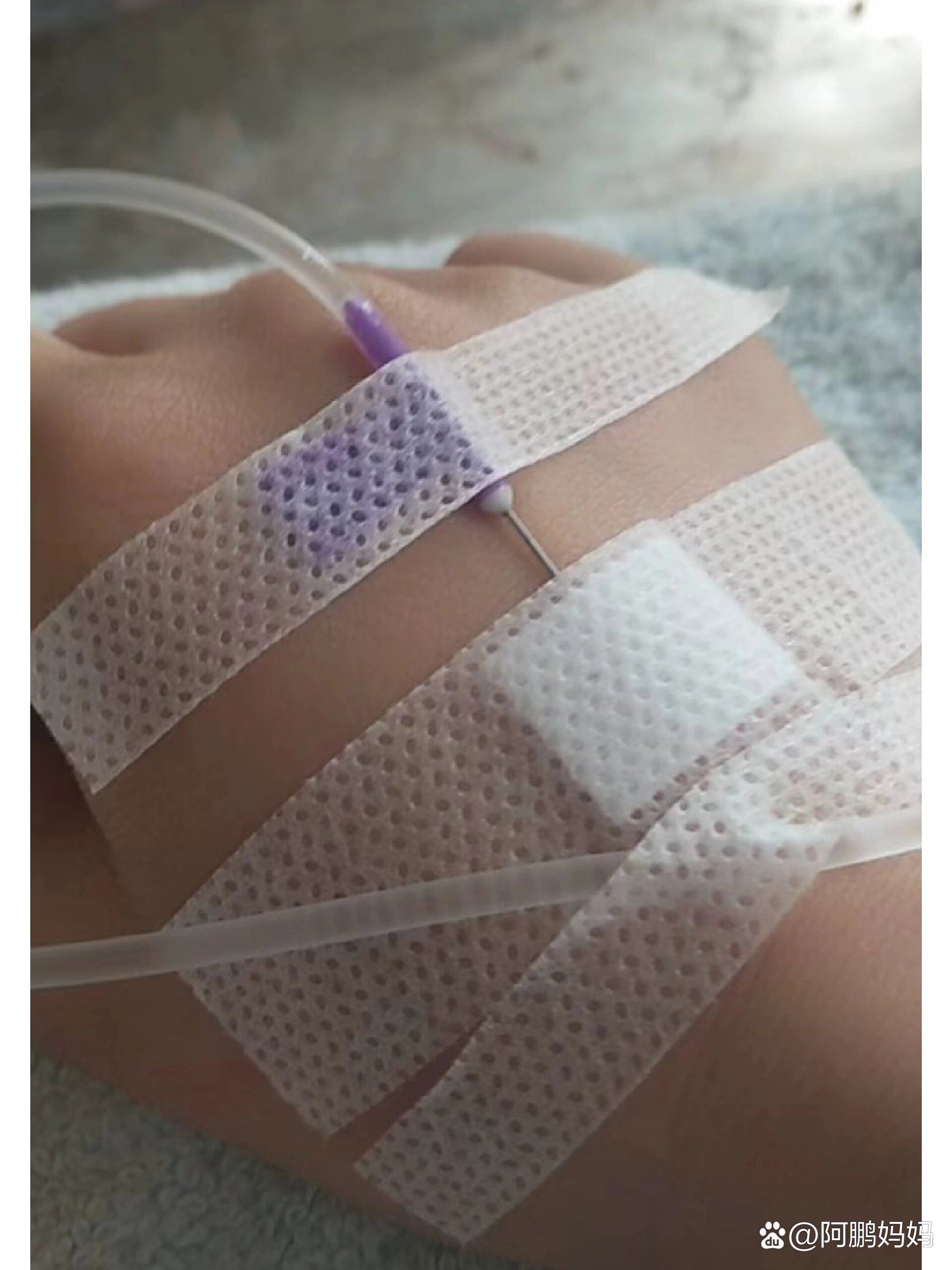 一个人打吊针静静地看着吊针慢慢的滴,一瓶250ml的吊瓶水一共是3869滴