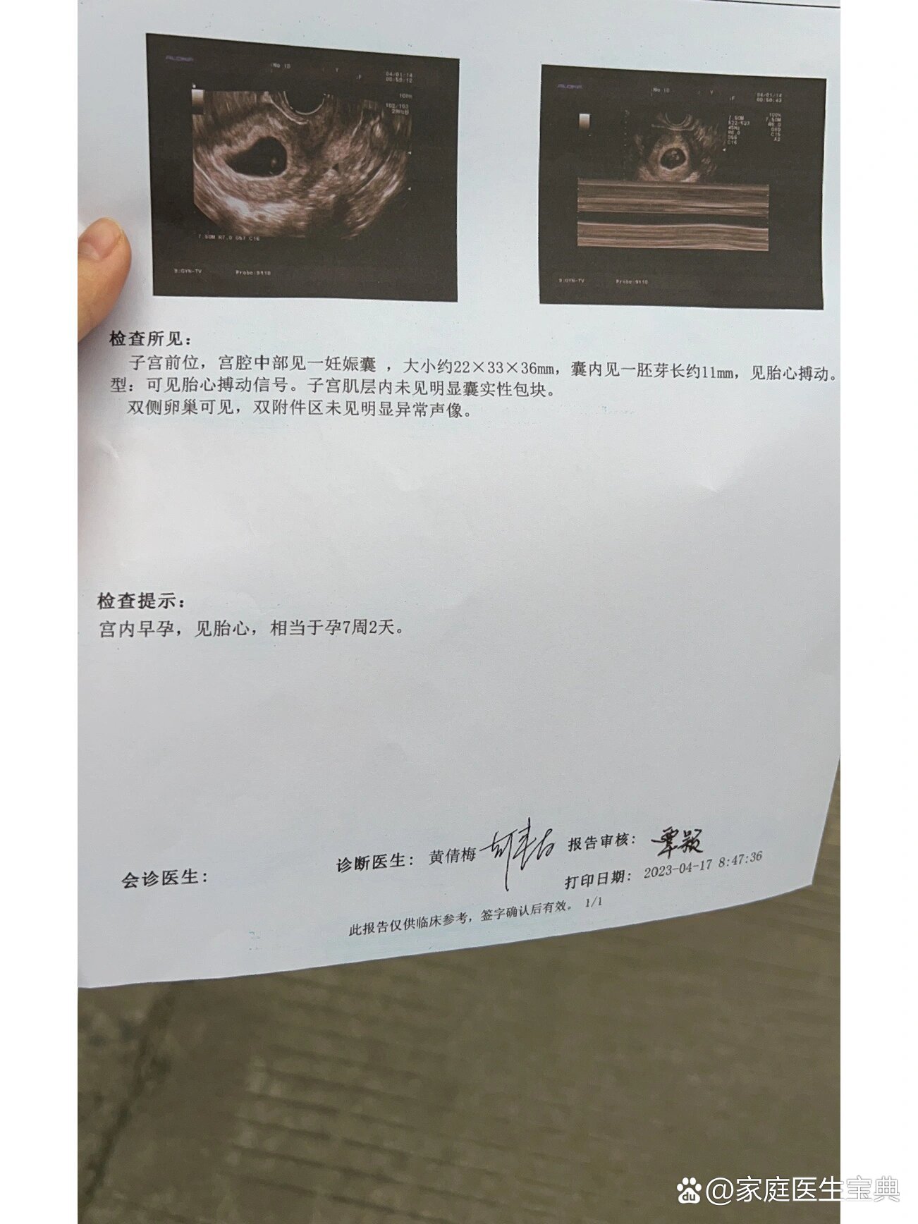看到胎心胎芽了但是孕酮低 医生说孕酮低会导致胚胎发育不良或者胎停