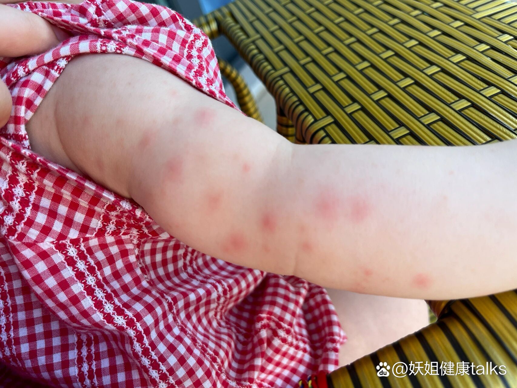 长红疹子 br>手足口第一针疫苗后两只手臂长红疙瘩,不知道是过敏反应