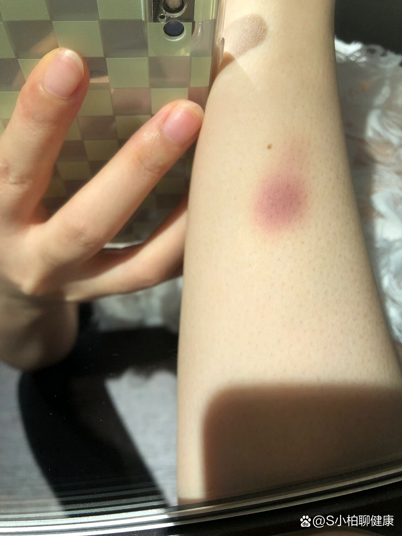 手臂上突然有红了一块儿,不痛不痒