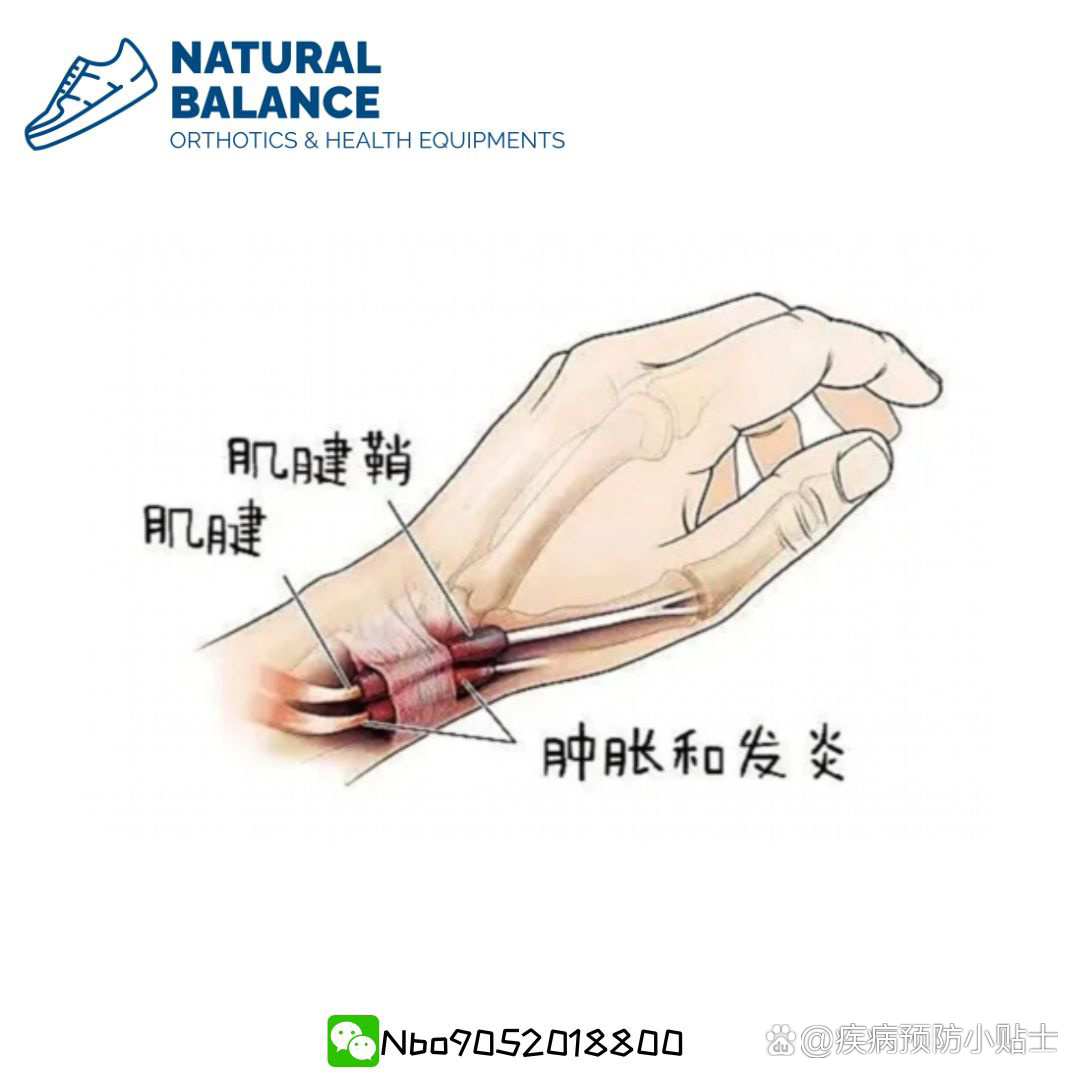 带你了解手腕腱鞘炎