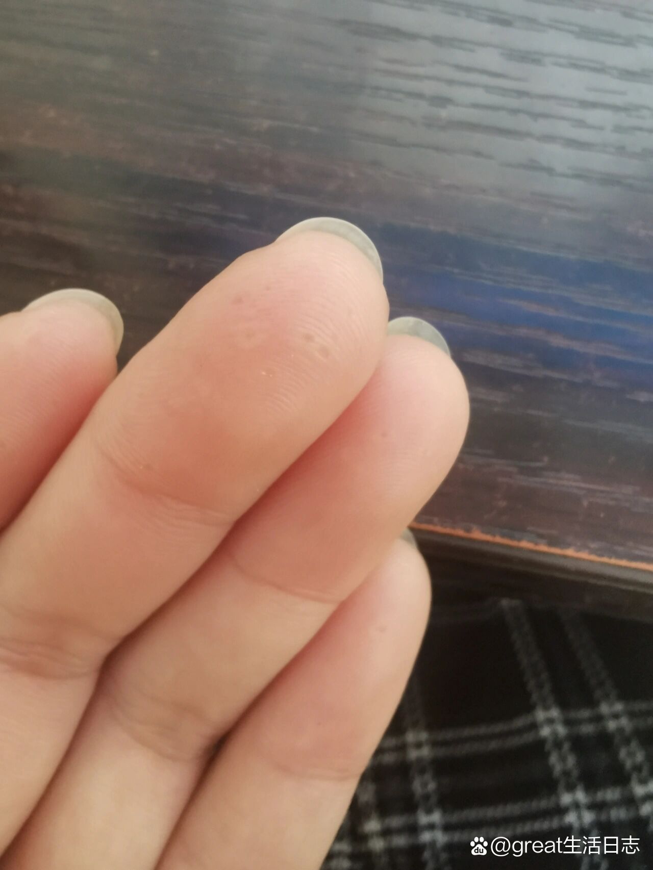  p>这是什么…… br>有人知道手指肚上长的这种是什么吗?