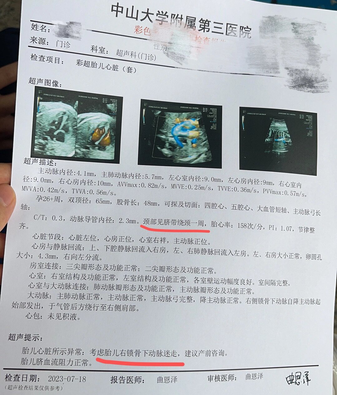 胎儿心脏彩超右锁骨下动脉迷走