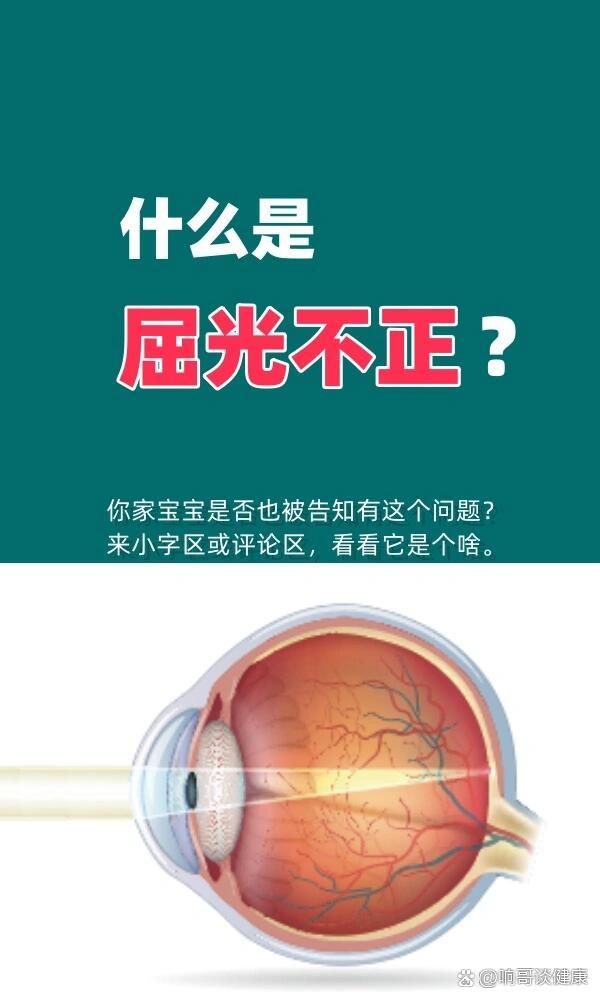 屈光,就是"曲折光线"的意思