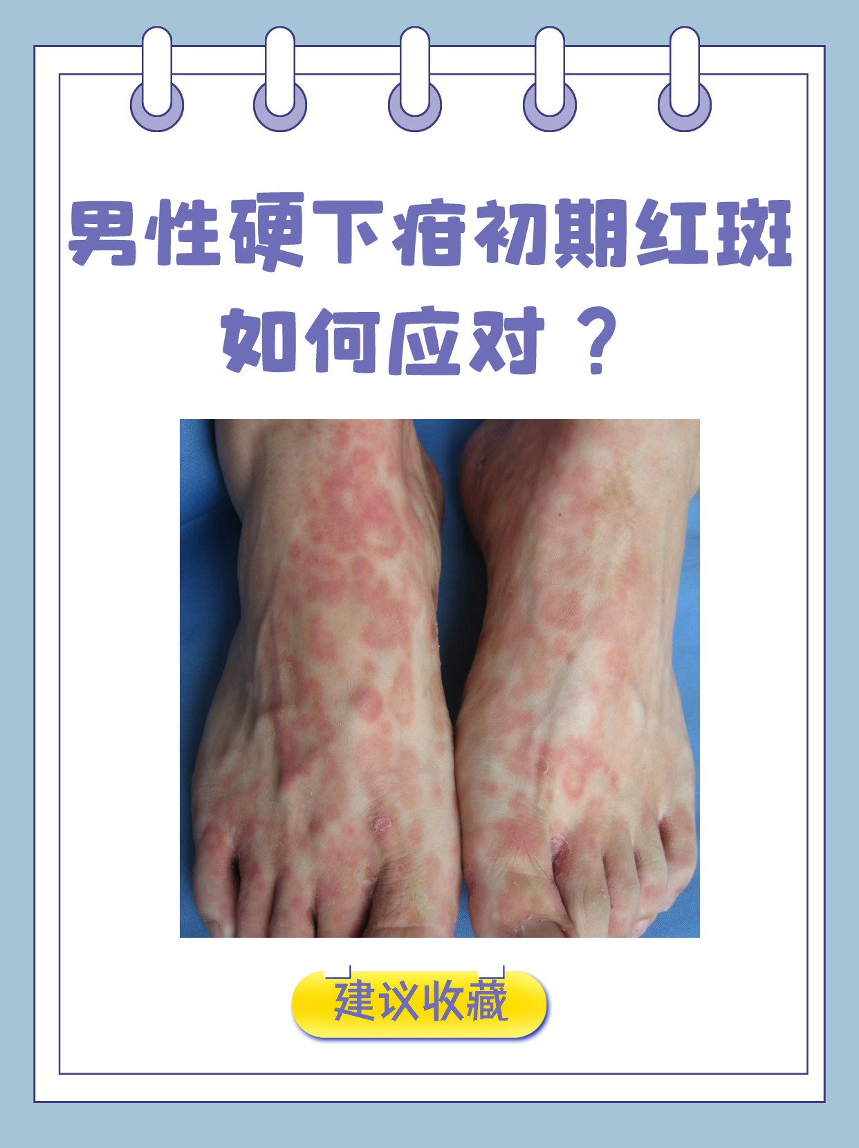 男性硬下疳初期红斑,如何应对?