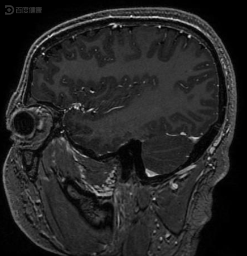 弥漫性星形细胞瘤早发现,及时治疗预后好