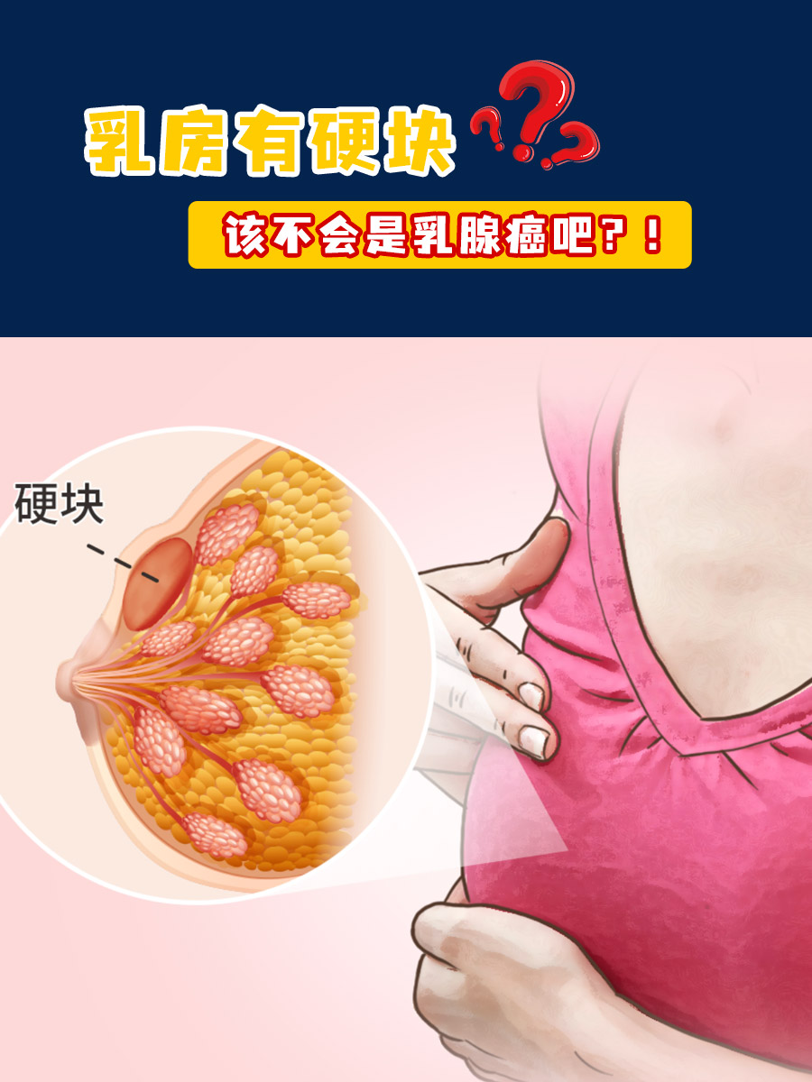 乳房抓起来有一坨硬块?该不会是乳腺癌吧?