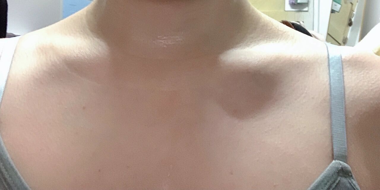 锁骨不明显是为什么