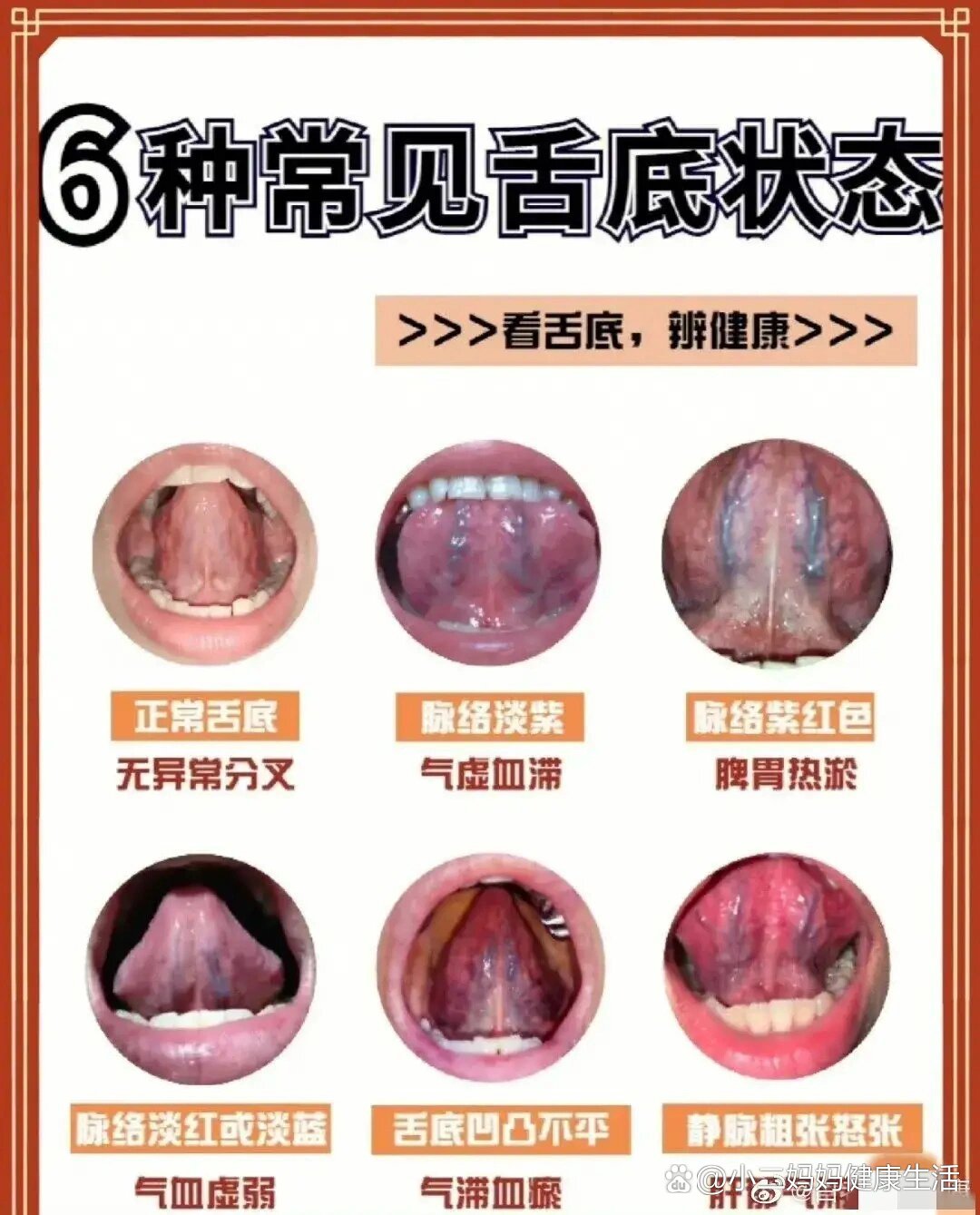 舌底有小疙瘩图片图片