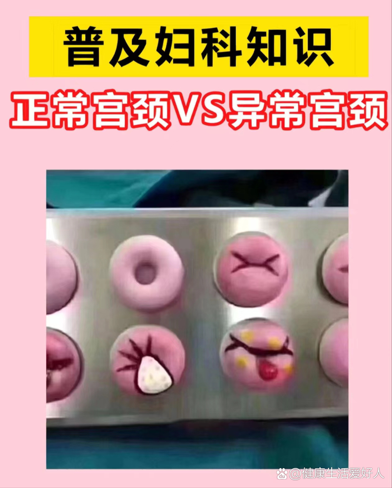 正常的宫颈:没有经阴道分娩的女性,其宫颈表面光滑,外观是圆形的 br>2