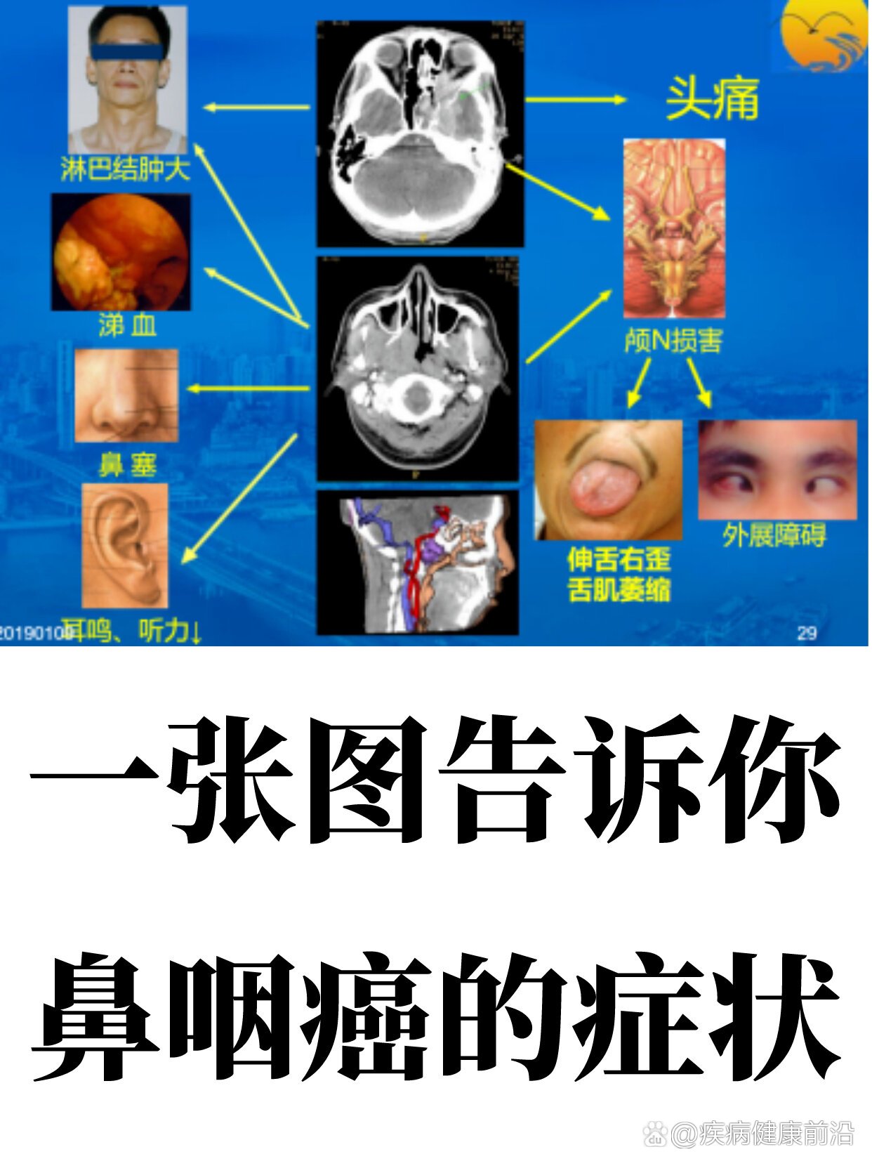 鼻咽癌的最明显症状图片