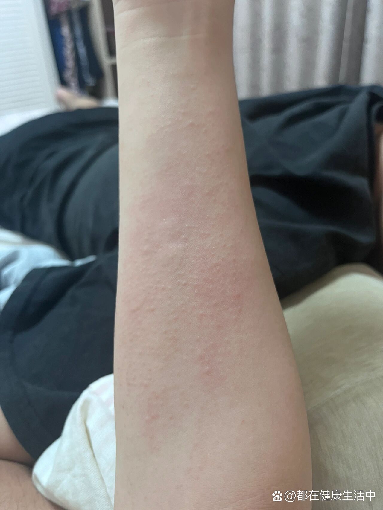 右手臂痒了一个多月了