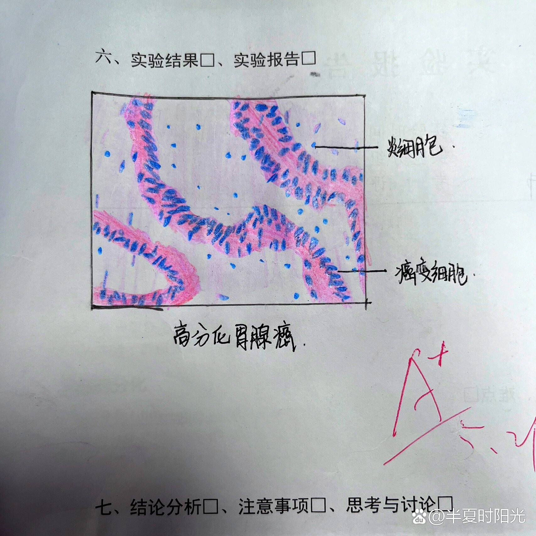 病理切片|高分化胃腺癌