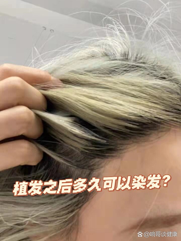 月薪可以植发(植发耽误工作吗)