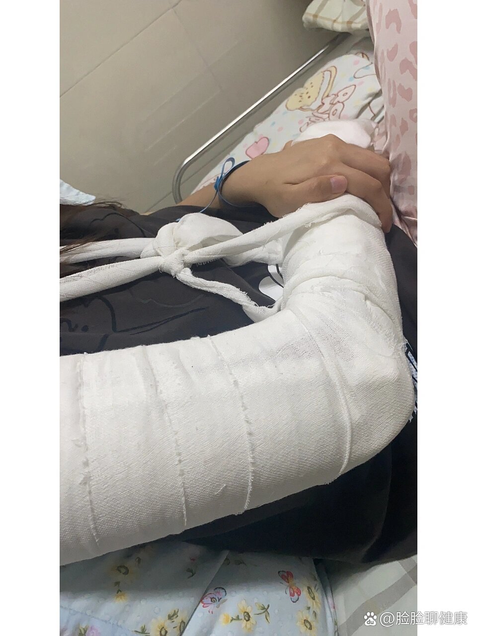 右肱骨骨干骨折