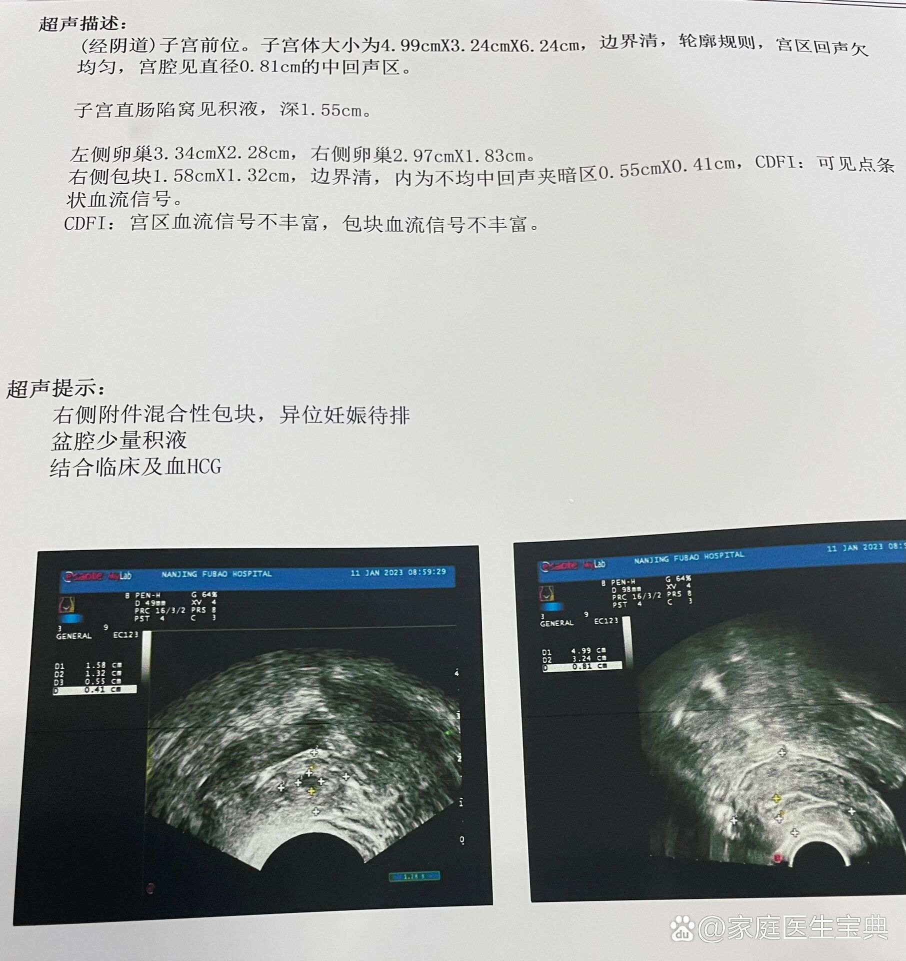 记录一次宫外孕的全过程(下)